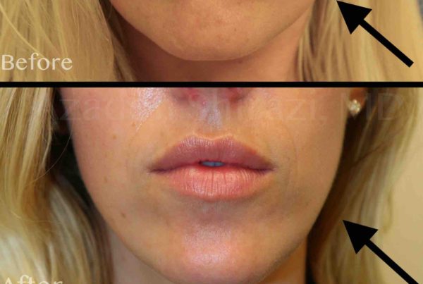 Woman Before & After Facial Sculpting