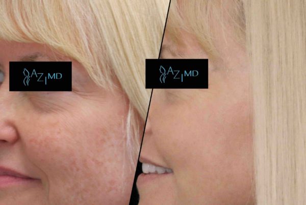 Woman Before & After Halo Laser Treatment