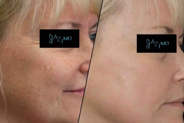 Woman Before & After Deep Wrinkle & Sun Damage Treatment