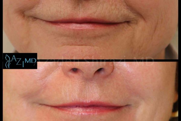 Mouth Area Before & After Deep Wrinkle Treatment