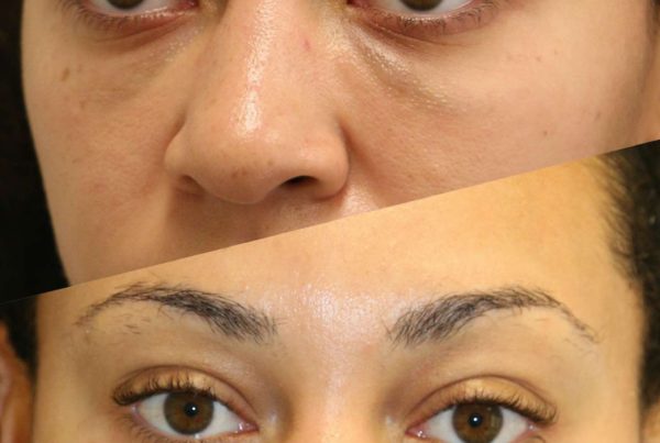 Close Up Of Woman After Eye Rejuvenation