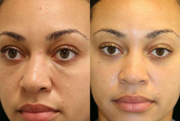 Woman After Non Surgical Face Conturing