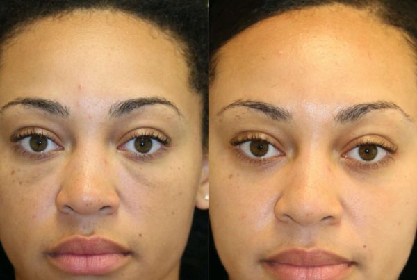 Before & After Non Surgical Facial Rejuvenation