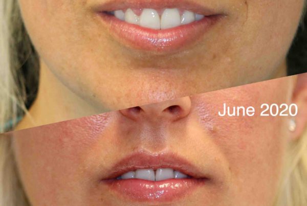 Woman Before & After Lip Rejuvenation