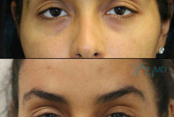 Woman Before & After Eye Lift Fillers