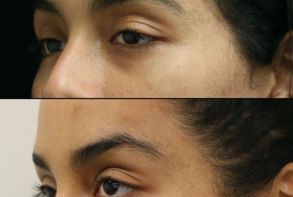 Profile Of Woman Before & After Eye Rejuvenation