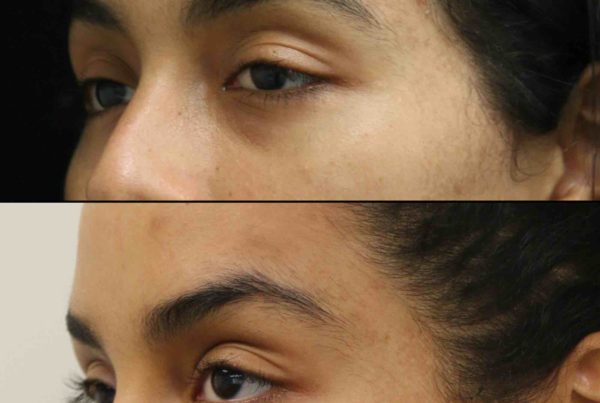 Woman Before & After Cosmetic Eye Lid Fillers