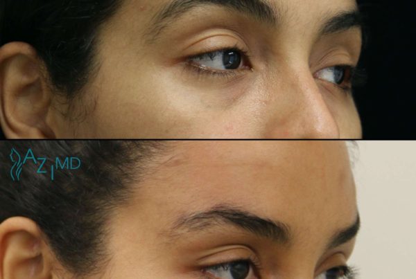Woman Before & After Eye Rejuvenation