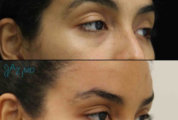 Woman Before & After Cosmetic Eye Fillers