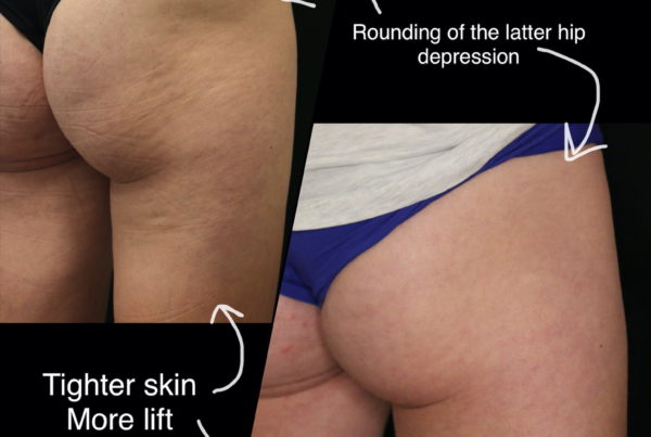 Woman Before & After Sculptra Butt Lift