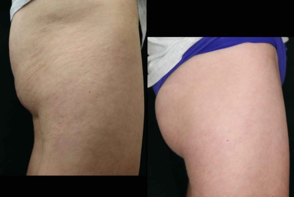 Woman Before & After Non Surgical Butt Lift