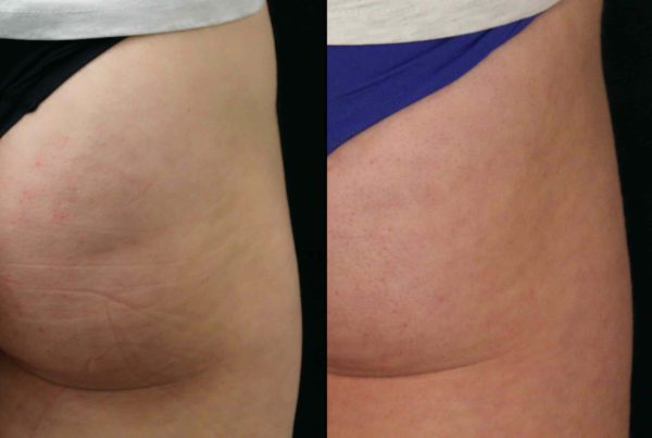 Close Up Of Woman Before & After Lower Buttock Lift