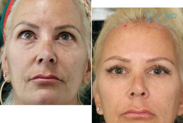 Woman Before & After Using Face Filler Injections