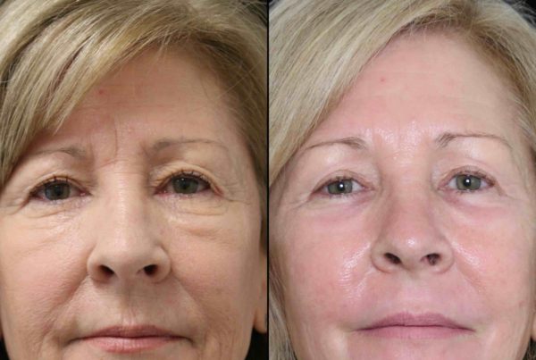 Woman's Face Before & After Non Surgical Face Contouring