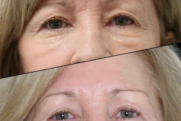 Person's Eyes Before & After Eye Rejuvenation