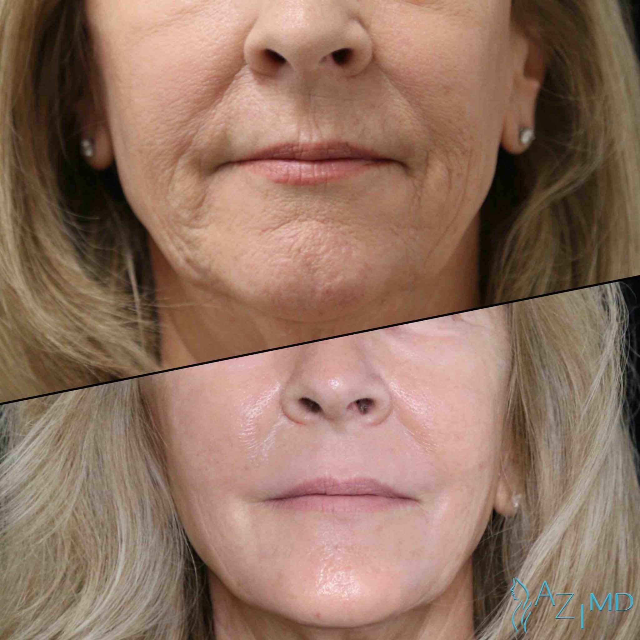 Contour Laser La Jolla Dermatology