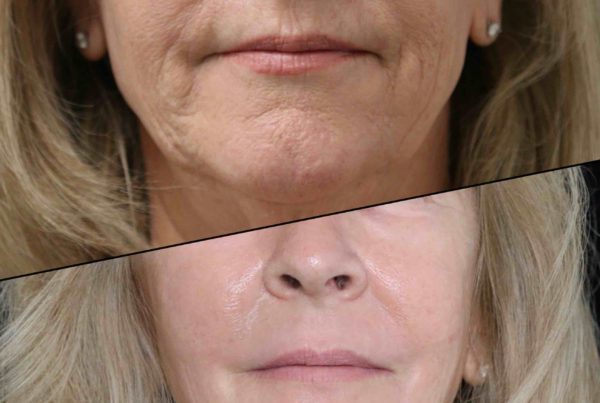Bottom Of Woman's Face Before & After Deep Wrinkle Treatment