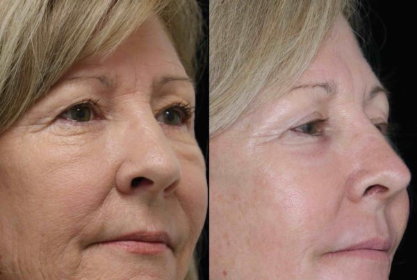 Woman Before & After Results Of Deep Wrinkle Reducer