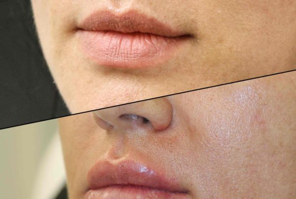 Woman Before & After Lip Threading
