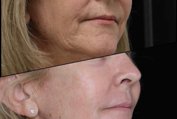 Woman Before & After Deep Wrinkle Reducer