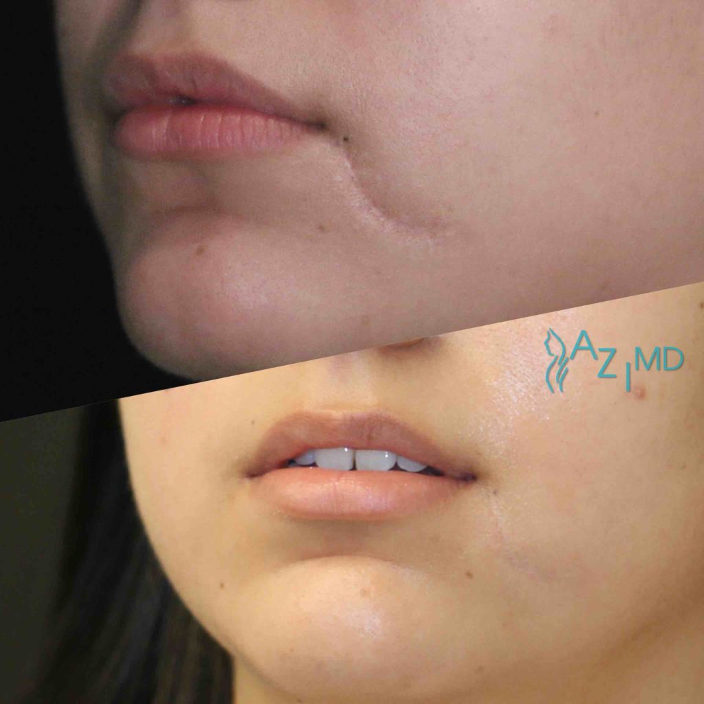 Scar Revision La Jolla Dermatology And Laser Surgery Center