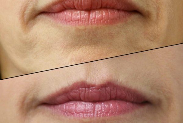 Woman's Lips Before & After Botox Lip Treatment