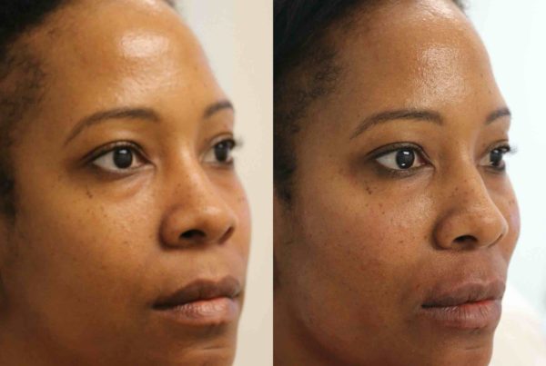 Woman Before & After Facial Rejuvenation