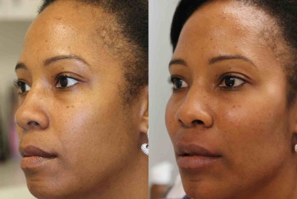 Before & After Non Surgical Facial Rejuvenation