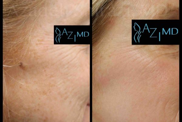 Close Up OF Woman Before & After Skin Damaged Skin Treatment