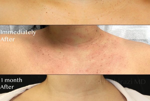 Woman's Chest Before & After Mole Removal