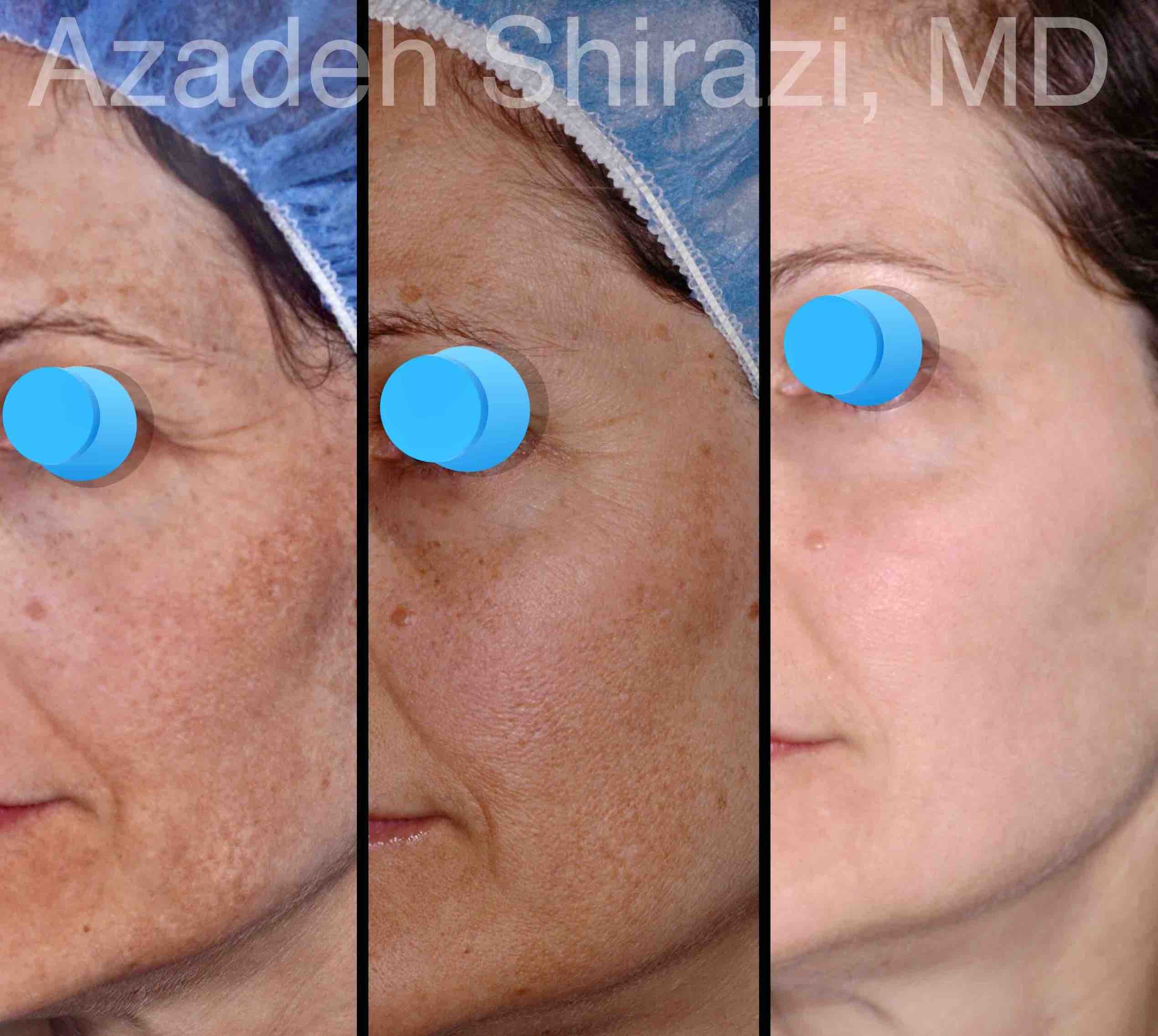 Woman Before And After Melasma Laser Treatment
