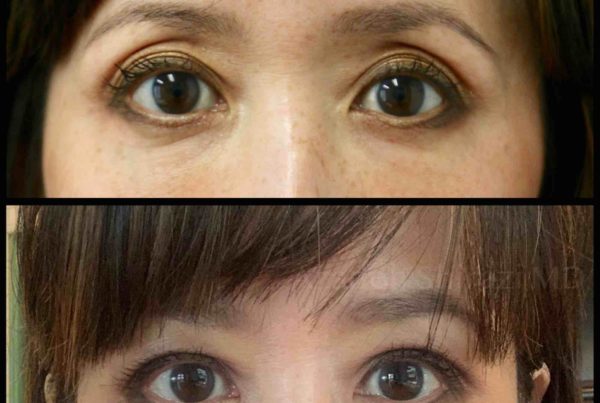 Woman Before & After Eye Lid Lift Without Surgery