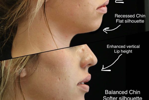 Profile Of Woman's Before & After Non Surgical Chin Augmentation