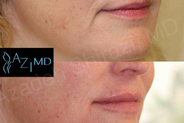 Woman's Lower Face Before & After Cosmetic Fillers