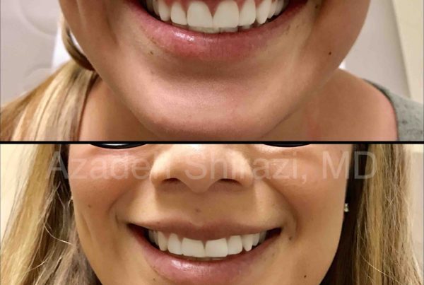 Woman's Lips Before & After Lip Rejuvenation