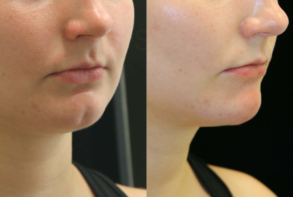 Woman's Before & After Non Surgical Chin Augmentation