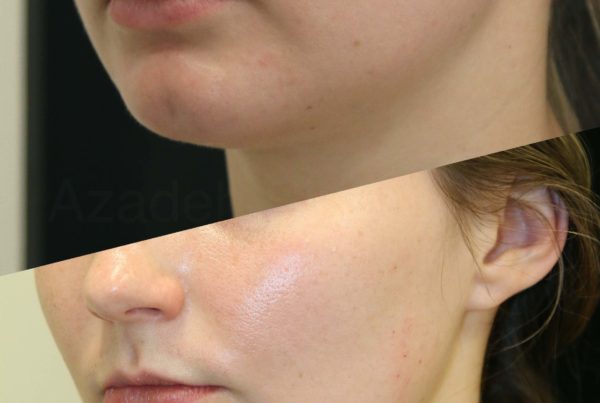 Woman's Before & After Non Surgical Chin Augmentation