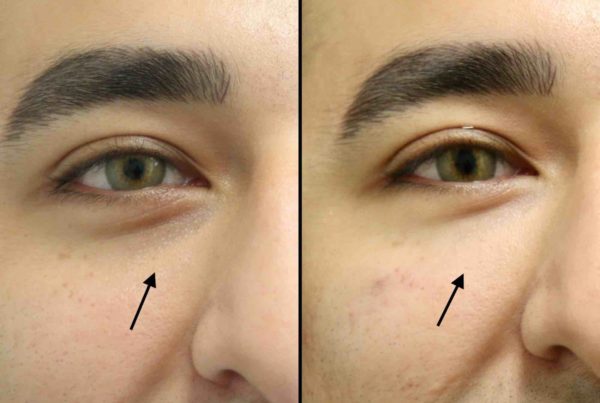 Man Before & After Eye Rejuvenation
