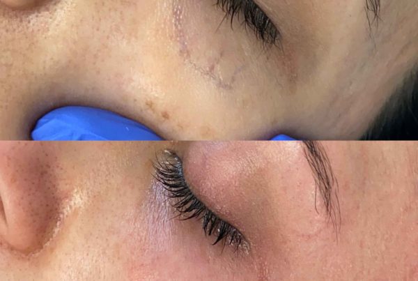 Woman Before & After Removing Spider Veins On Face