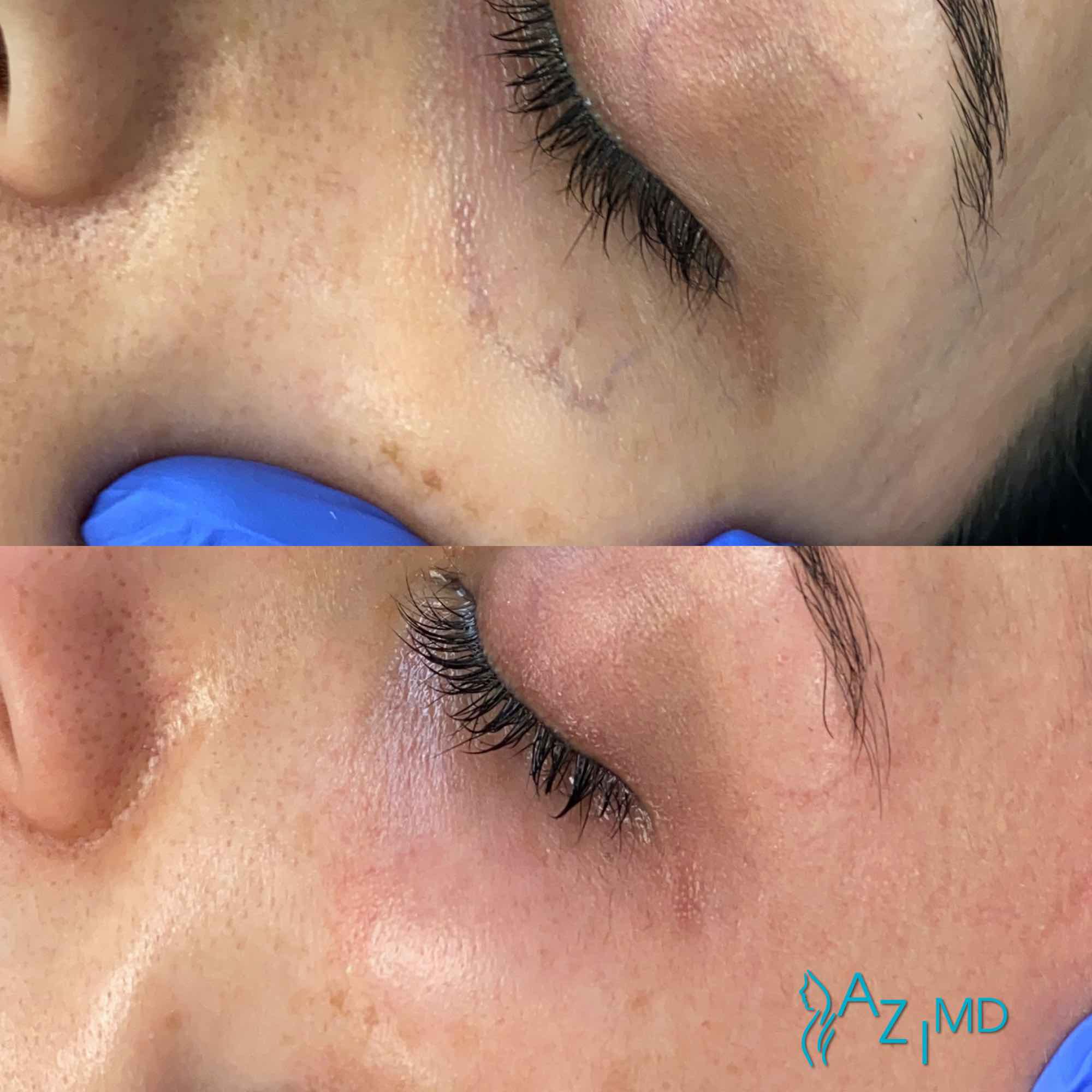 Woman Before & After Removing Spider Veins On Face