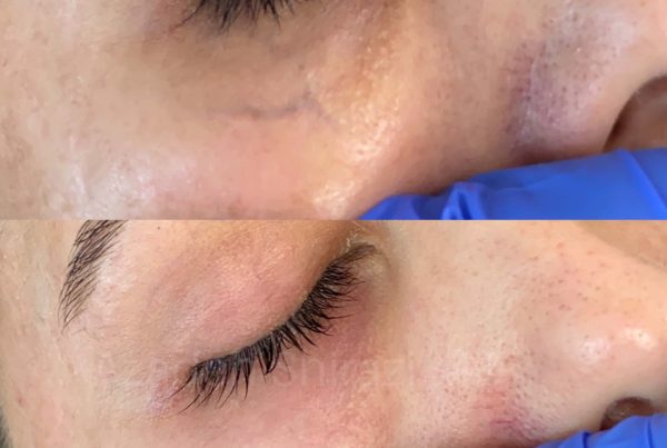 Woman Before & After Spider Vein Removal On Face