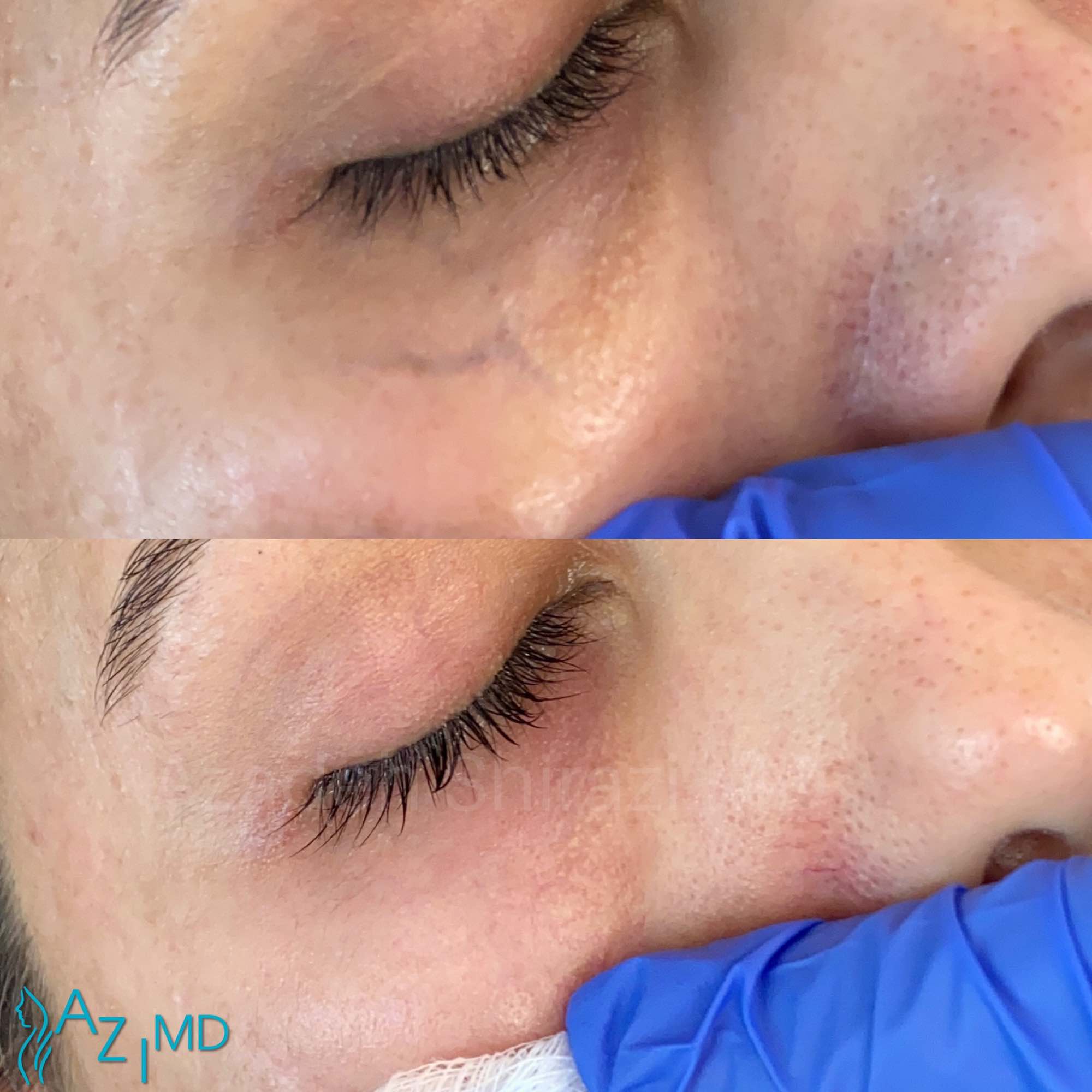 Woman Before & After Spider Vein Removal On Face
