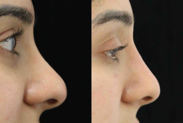 Woman Before & After Non Invasive Rhinoplasty