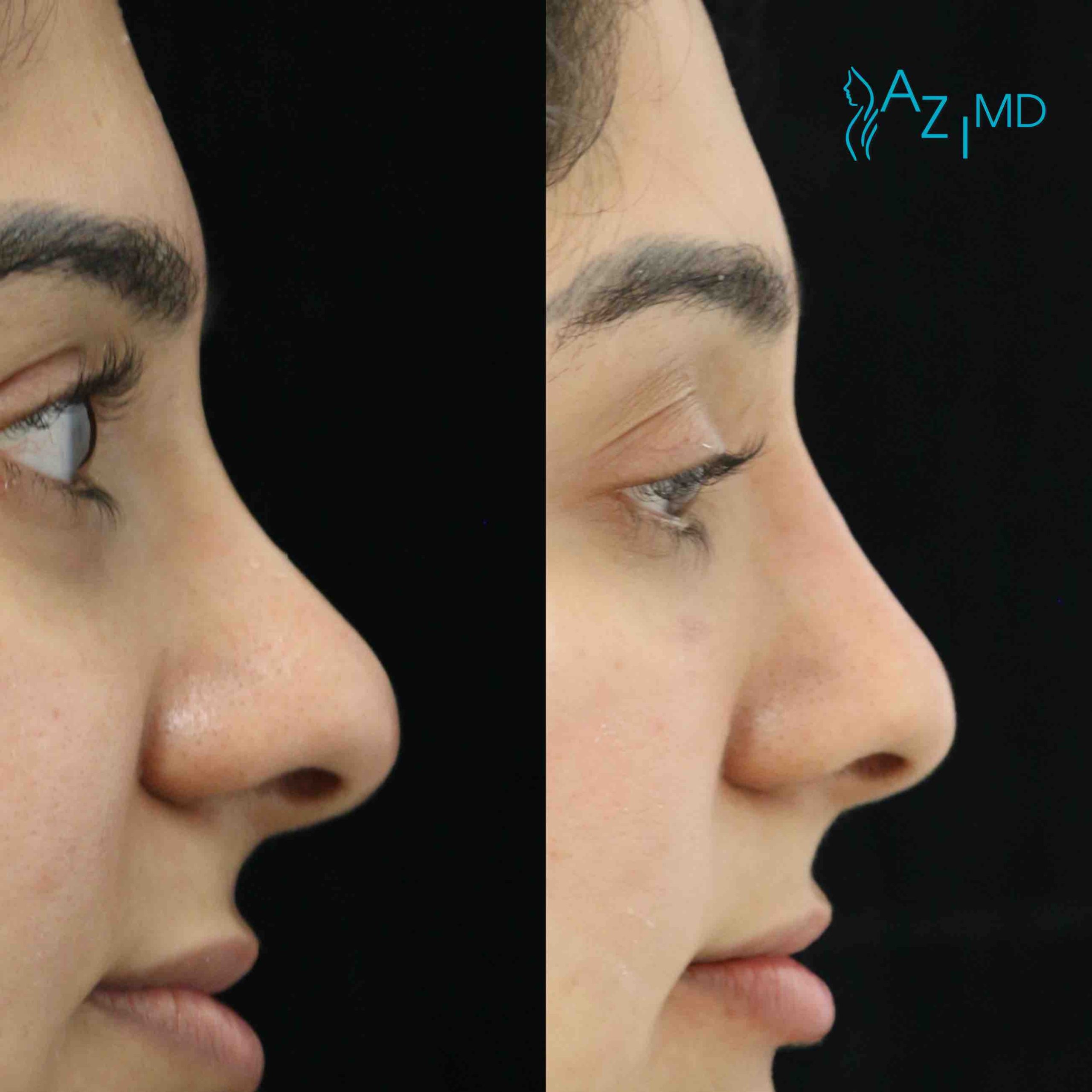 Woman Before & After Non Invasive Rhinoplasty