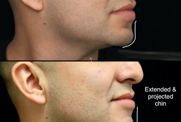 Profile Of Man Before & After Non Surgical Chin Augmentation