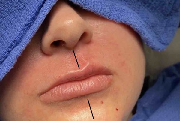 Woman During Non Surgical Lip Rejuvenation
