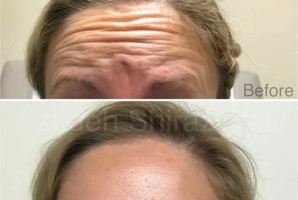 Woman Before & After Botox Injections To Forehead