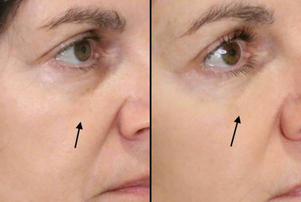 Before & After Results OF Eye Rejuvenation