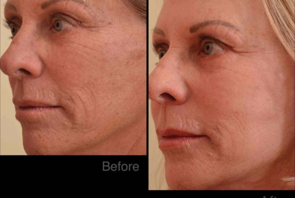 Profile Of Woman Before & After Deep Wrinkle Treatment