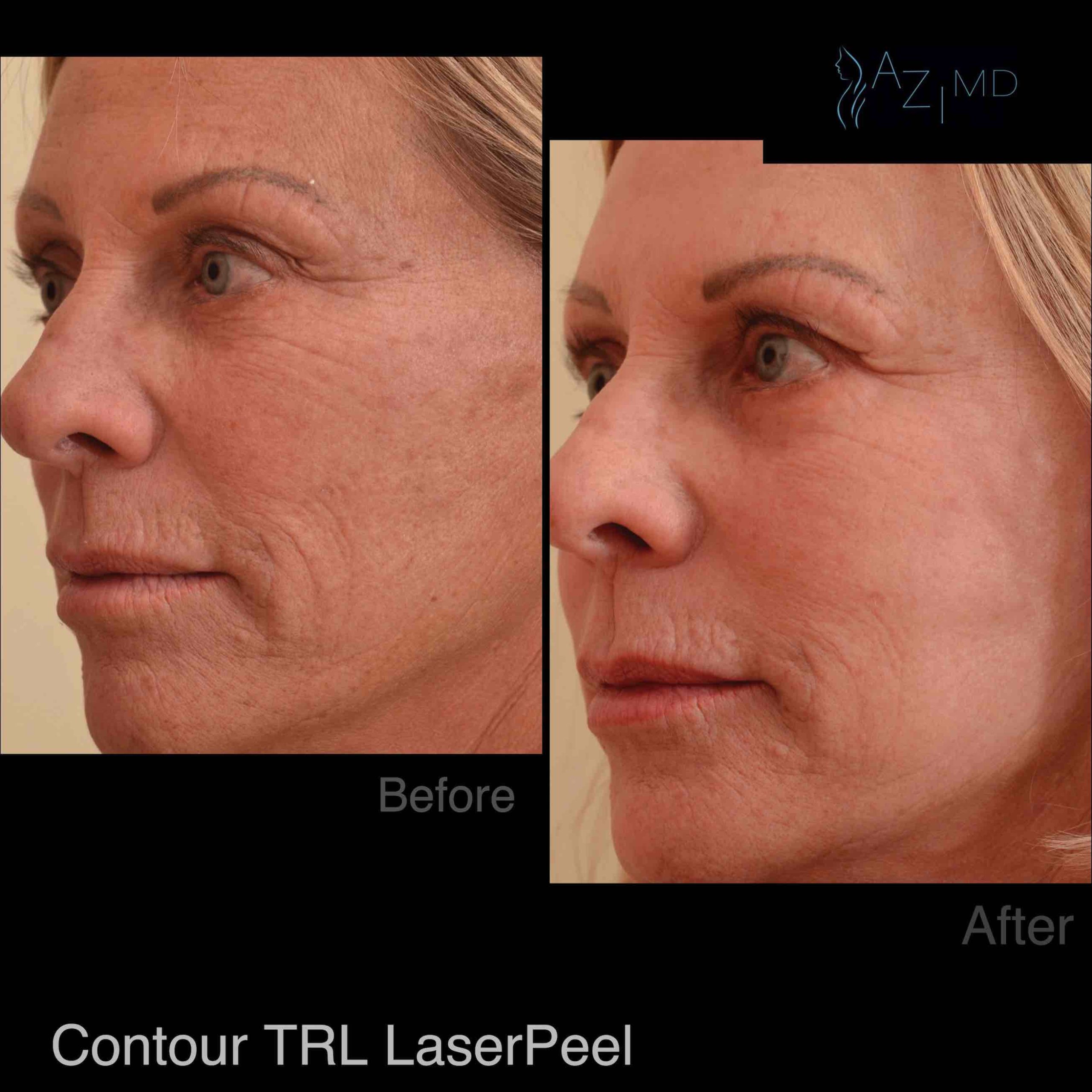 Profile Of Woman Before & After Deep Wrinkle Treatment